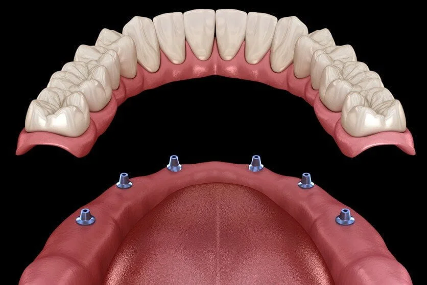 Dentures fitting