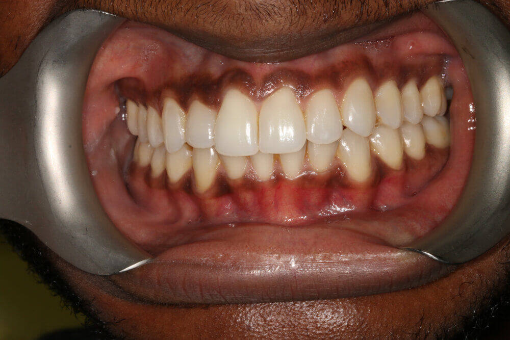 Gentle Dental - Straightening - after