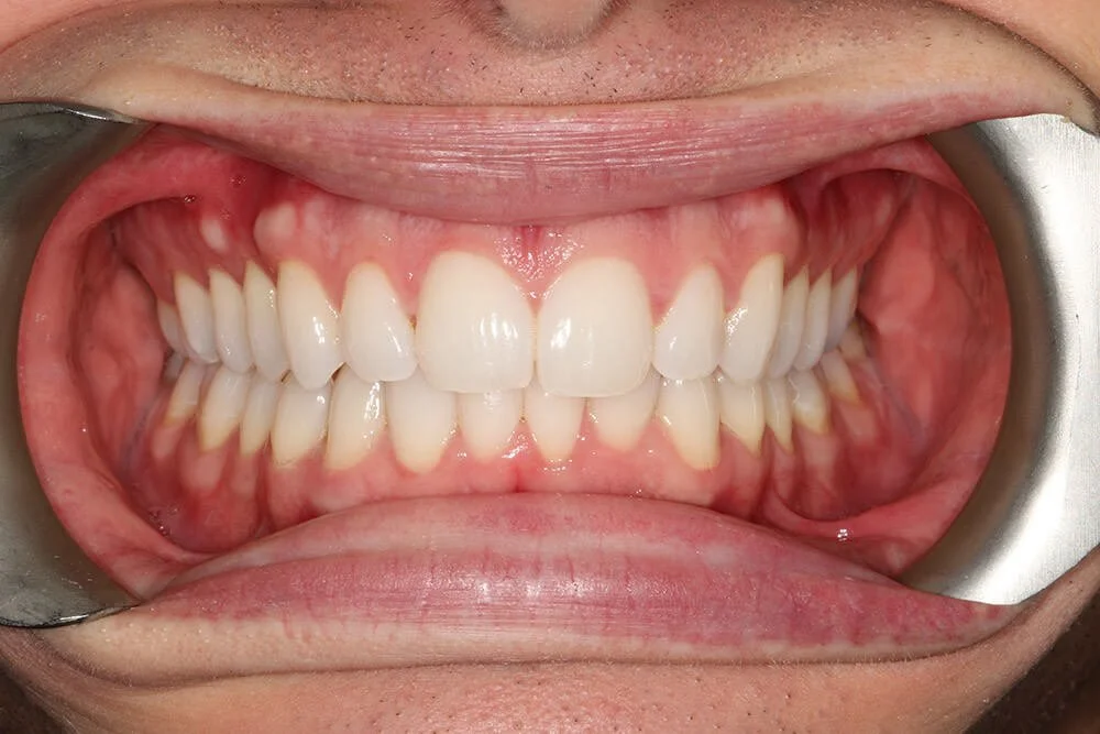 Gentle Dental - Straightening - after