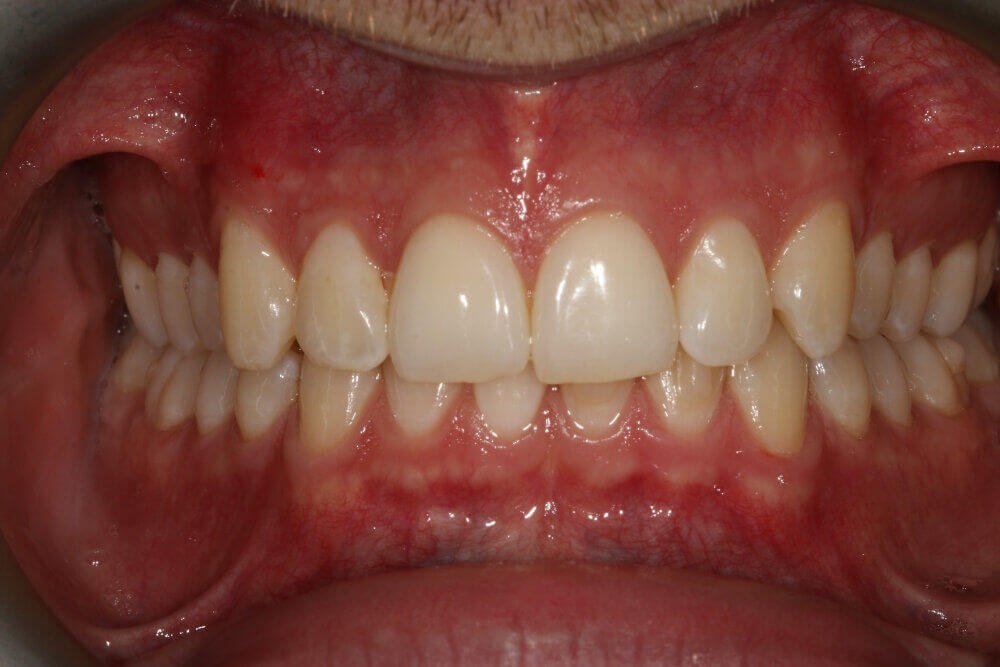 Gentle Dental - Straightening - after