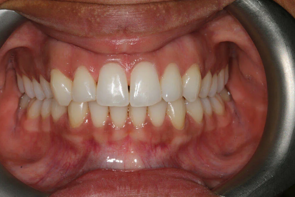 Gentle Dental - Straightening - after
