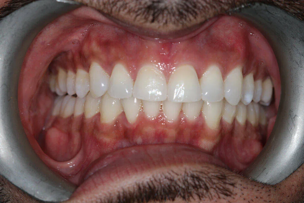 Gentle Dental - Straightening - after