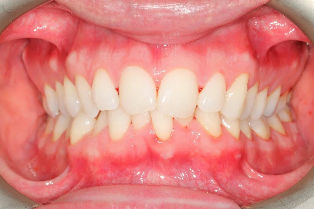 Gentle Dental - Straightening - before