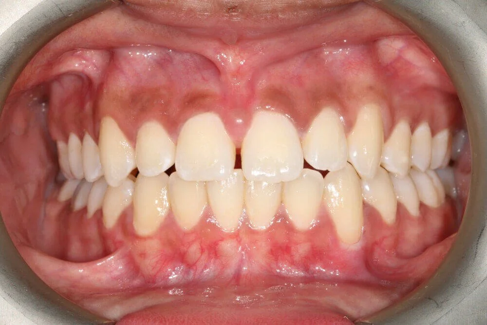 Gentle Dental - Straightening - before