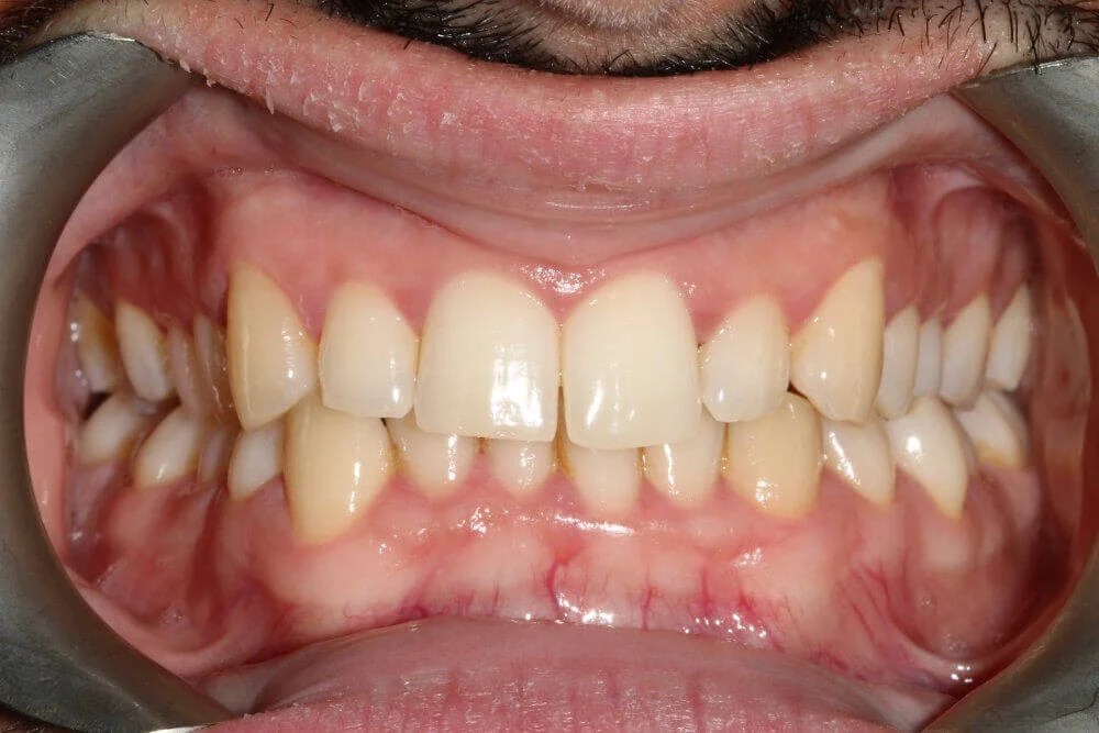 Gentle Dental - Straightening - before