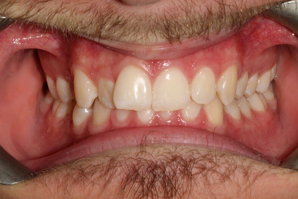 Gentle Dental - Straightening - before