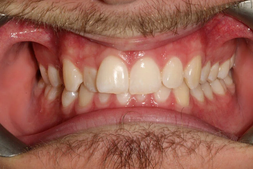 Gentle Dental - Straightening - before