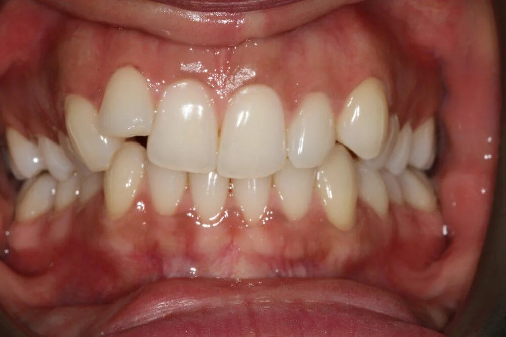 Gentle Dental - Straightening - before