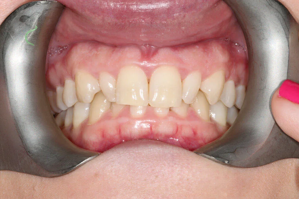 Gentle Dental - Straightening - before