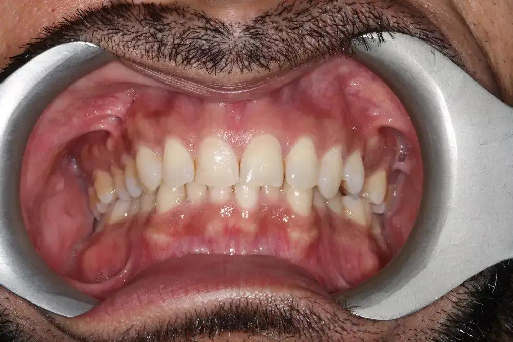 Gentle Dental - Straightening - before