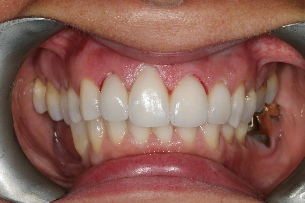 Gentle Dental - Teeth Whitening - after