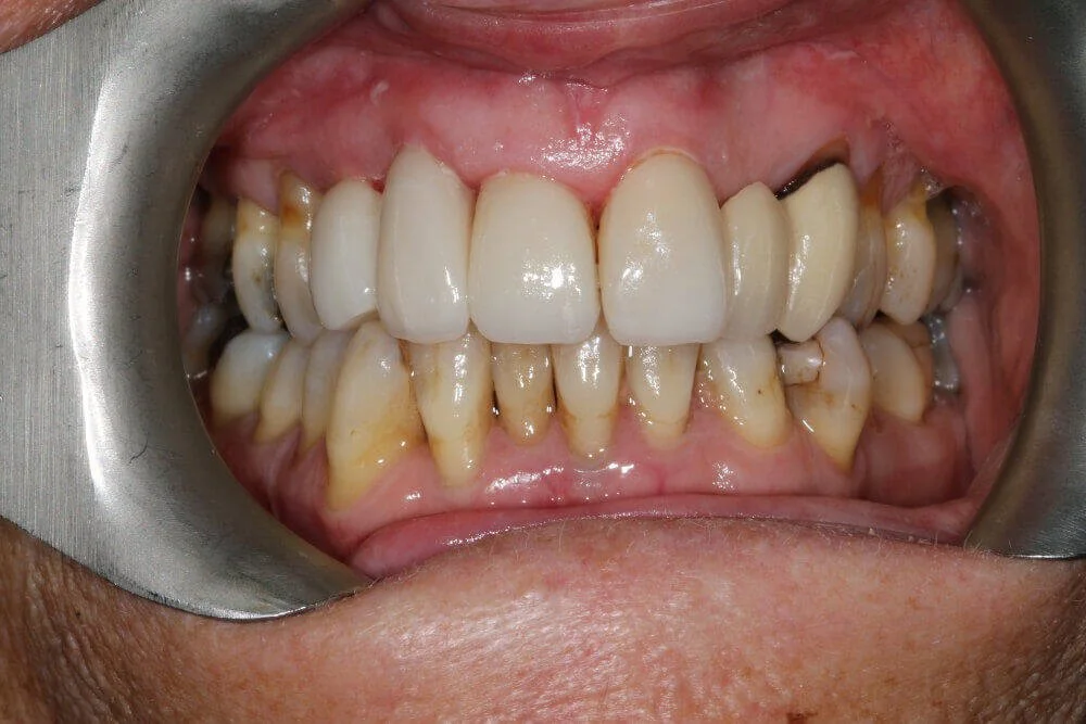 Gentle Dental - Teeth Whitening - after
