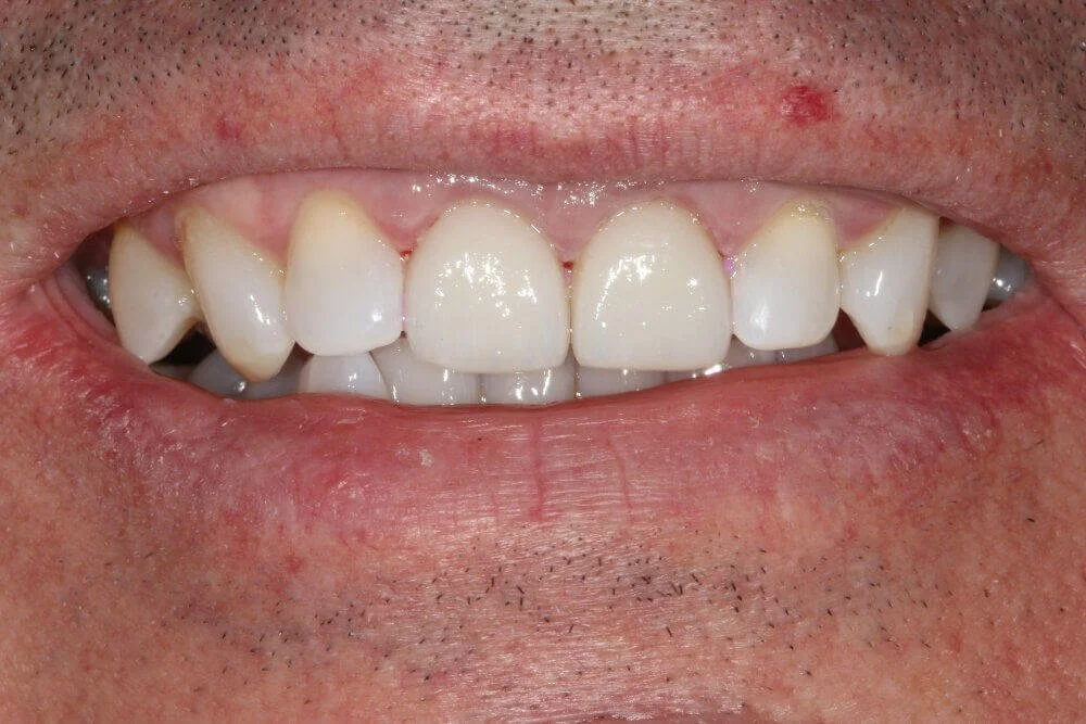 Gentle Dental - Teeth Whitening - after
