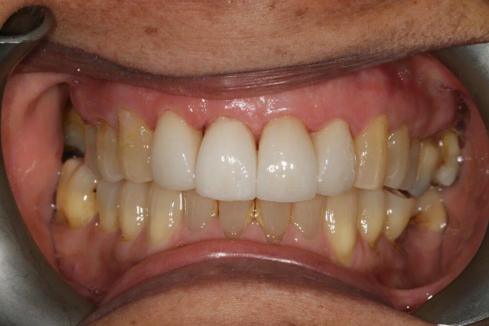 Gentle Dental - Teeth Whitening - after