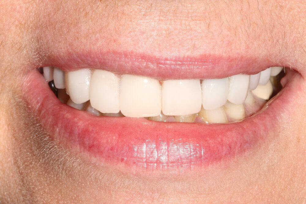 Gentle Dental - Teeth Whitening - after