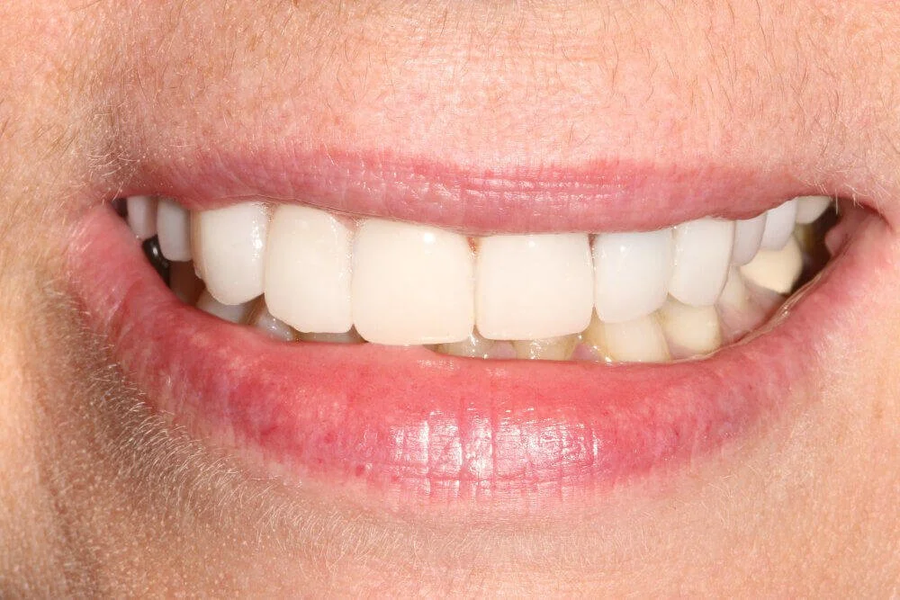 Gentle Dental - Teeth Whitening - after