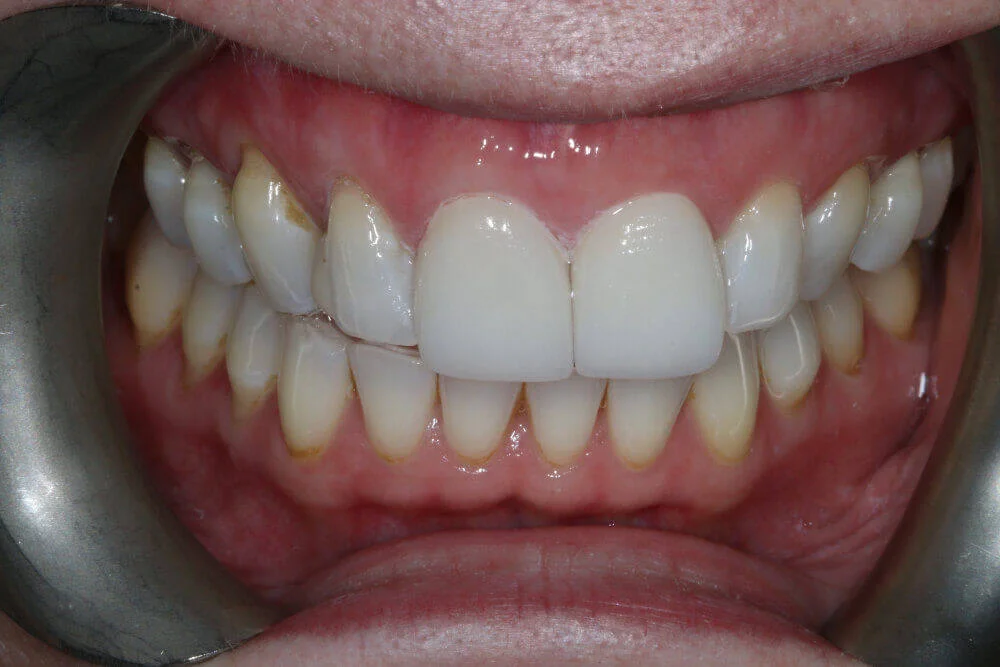 Gentle Dental - Teeth Whitening - after