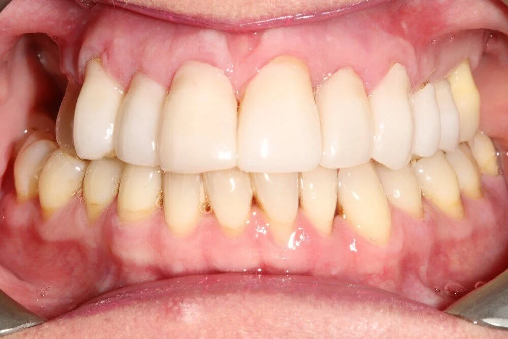 Gentle Dental - Teeth Whitening - after