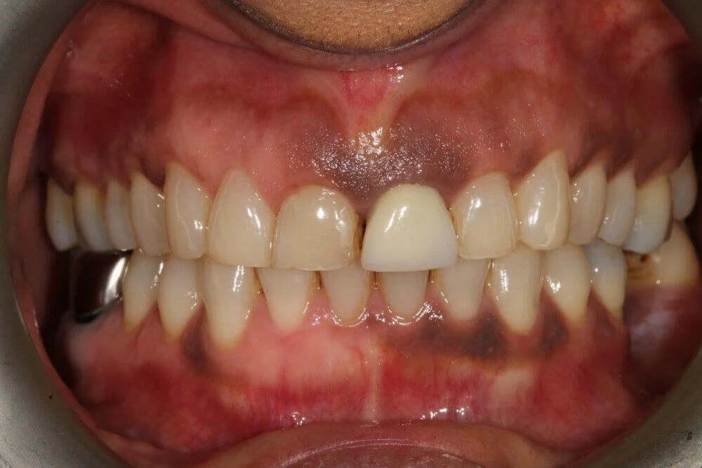 Gentle Dental - Teeth Whitening - before