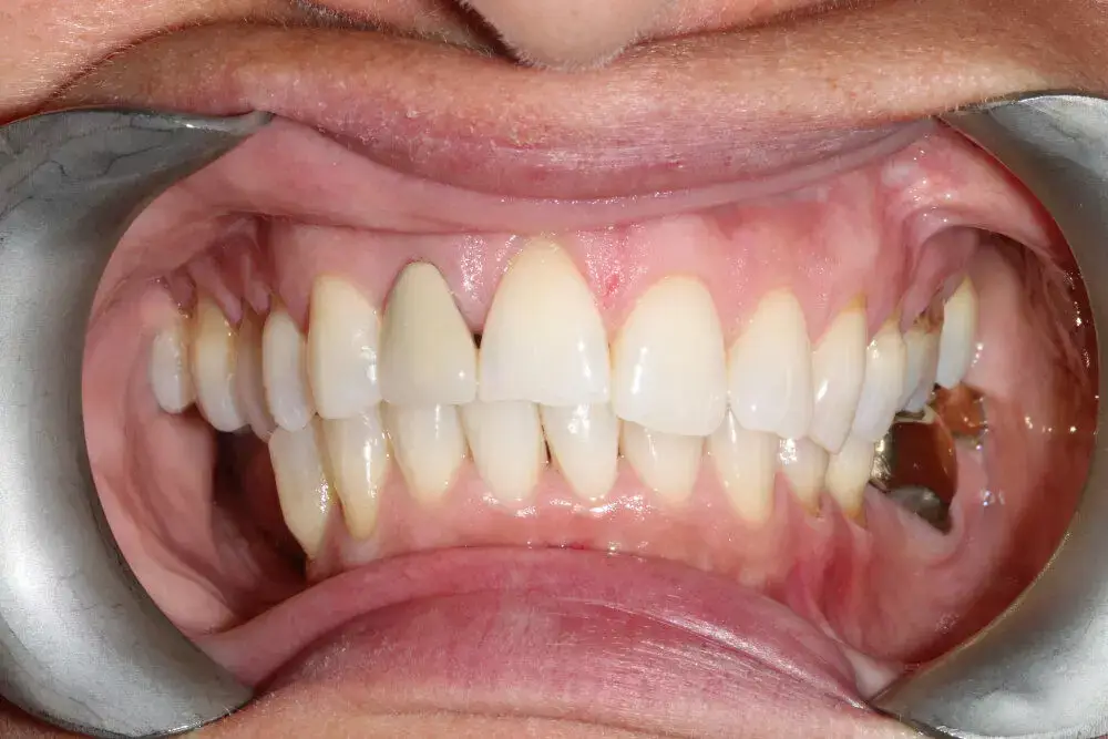 Gentle Dental - Teeth Whitening - before