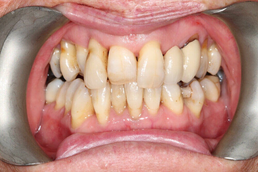 Gentle Dental - Teeth Whitening - before