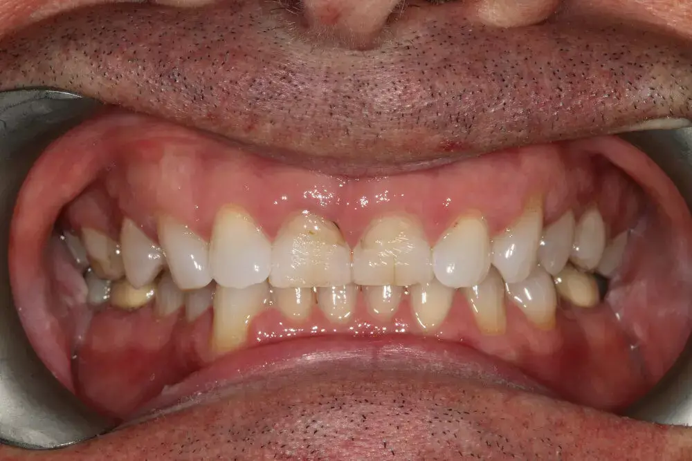 Gentle Dental - Teeth Whitening - before