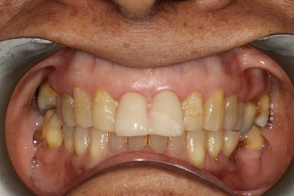 Gentle Dental - Teeth Whitening - before