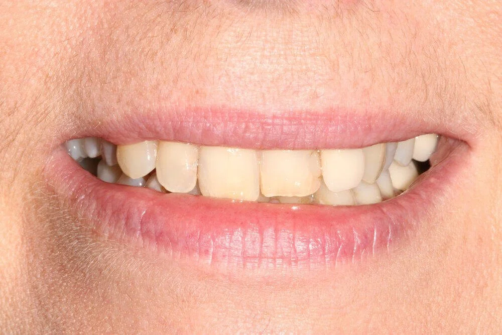 Gentle Dental - Teeth Whitening - before