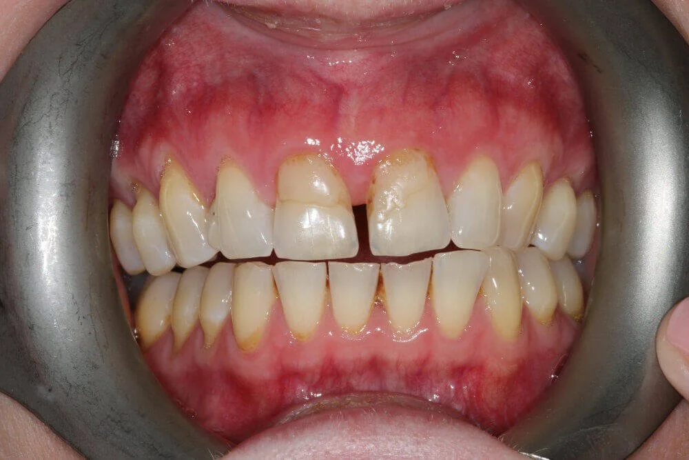 Gentle Dental - Teeth Whitening - before