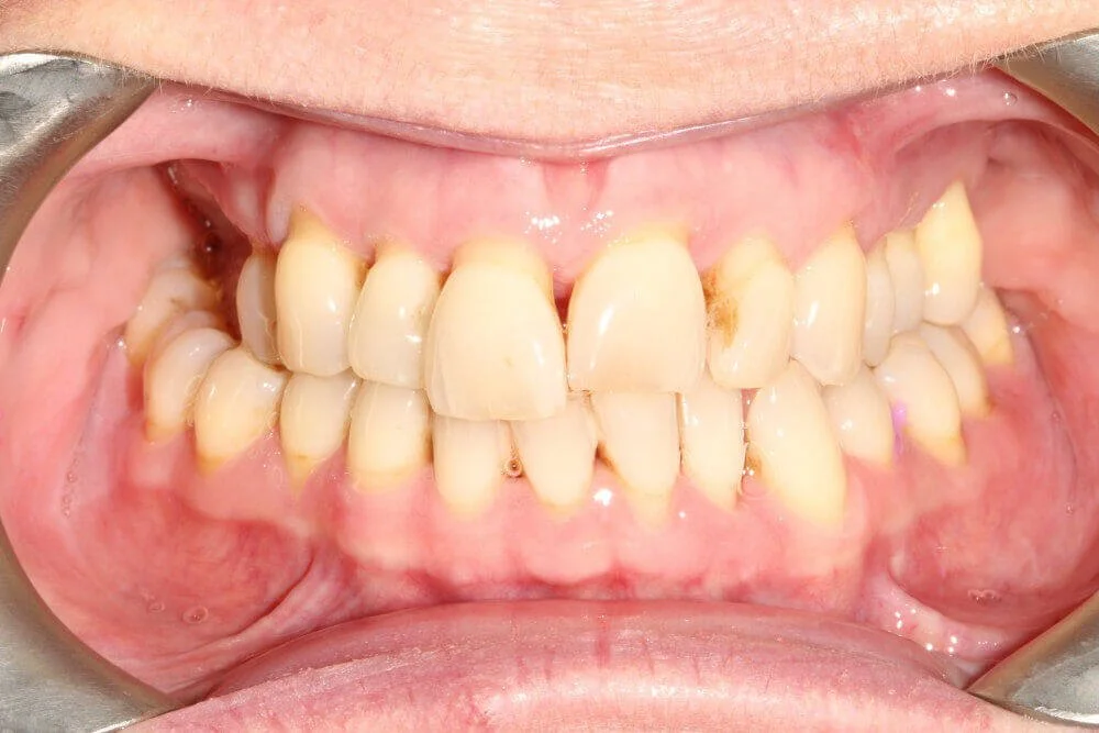 Gentle Dental - Teeth Whitening - before (8)