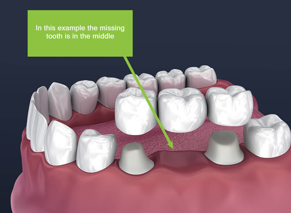 All you need to know about dental bridges