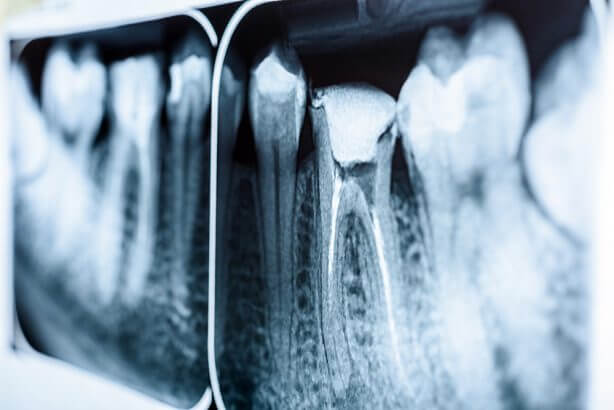 Everything you need to know about root canal treatment Everything you need to know about root canal treatment