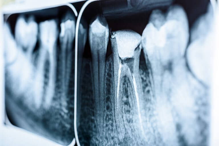 Everything you need to know about root canal treatment