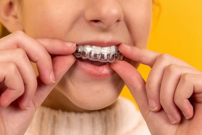 invisalign invisalign