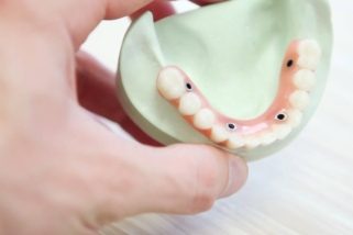 dental-bridge 321