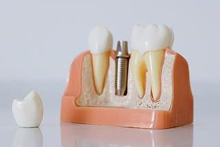 dental-implant-321×321 Gentle Dental Care