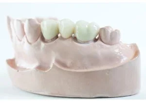 How Do Dentists Bridge Teeth?