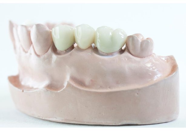 How Do Dentists Bridge Teeth?