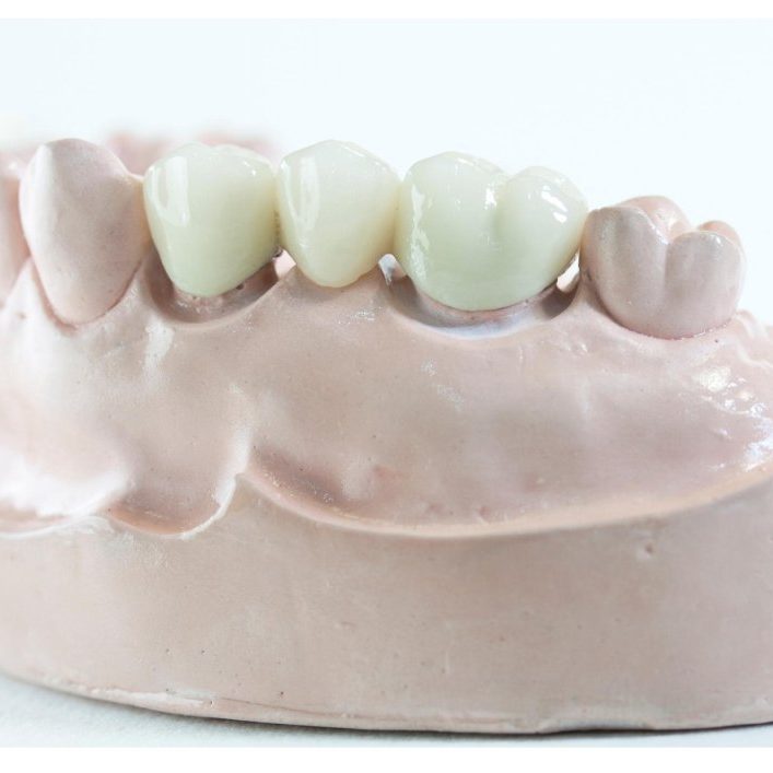 How Do Dentists Bridge Teeth?
