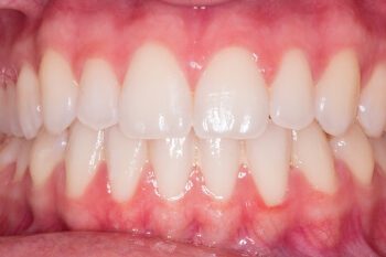 dental-gums-featured dental-gums