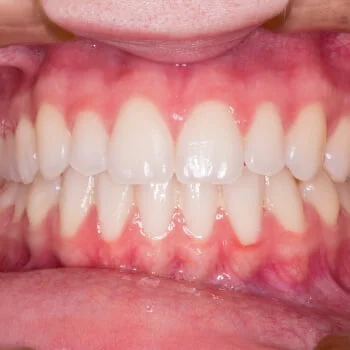 dental-gums