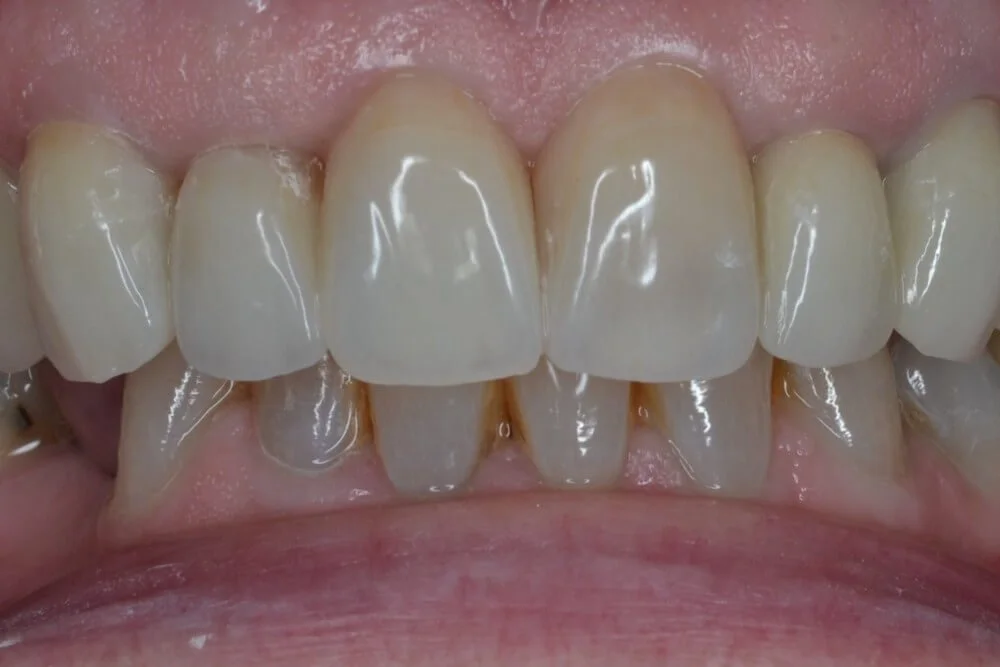 crown-bridges-veneers-AFTER