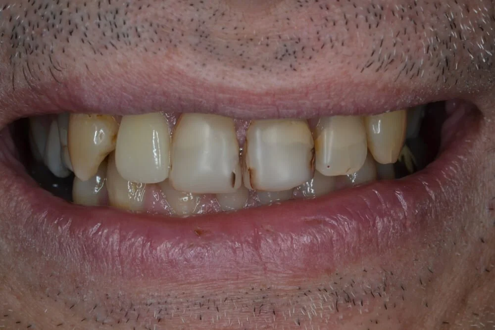 crowns-after