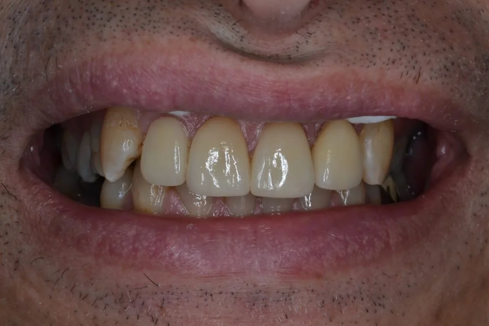 crowns-before