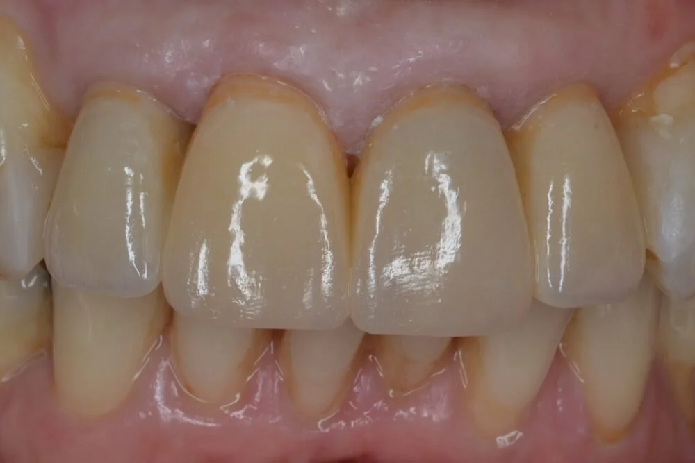 emax-crowns-veneers-AFTER
