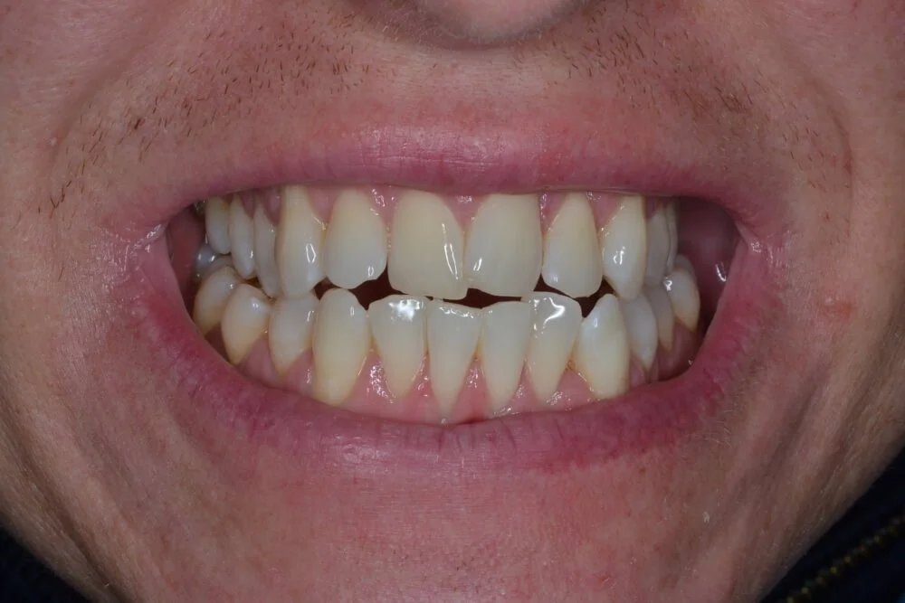 whitening-after