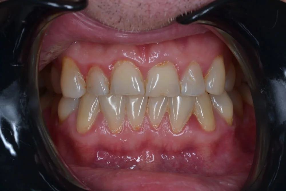 whitening-before
