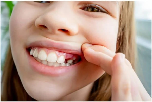 what-age-do-children-lose-teeth-2