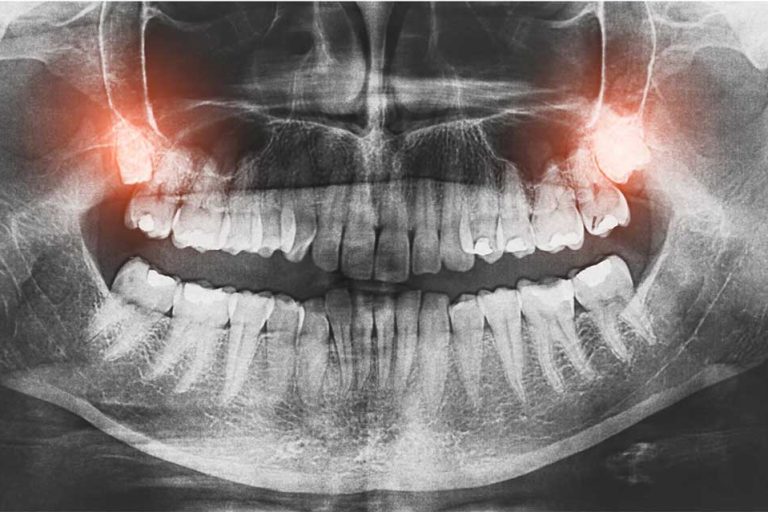 teeth-x-ray teeth-x-ray